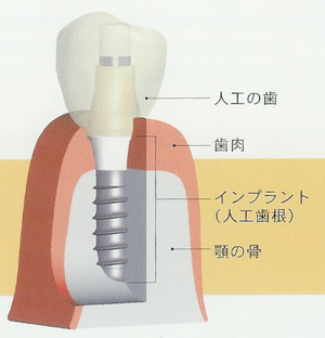 インプラント6